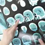 Hip Exoskeleton Cuts Walking Energy 20% for Stroke Survivors