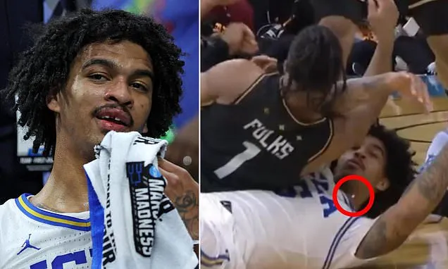 UCLA Guard Loses Tooth in March Madness Clash, Returns to Seal Win