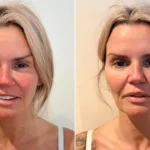 Kerry Katona Shares Energy Healing Results After Stroke Scare