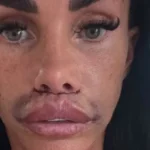 Katie Price Undergoes Corrective Surgery for Swollen, Scarred Lips