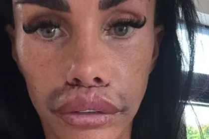 Katie Price Undergoes Corrective Surgery for Swollen, Scarred Lips