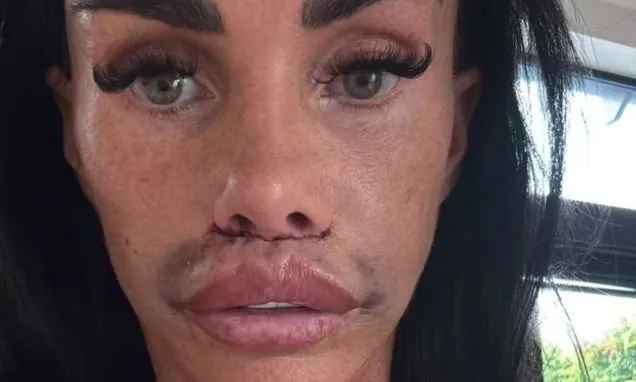 Katie Price Undergoes Corrective Surgery for Swollen, Scarred Lips